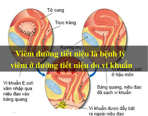Viêm đường tiết niệu